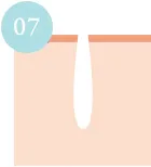 毛が生えてこなくなる